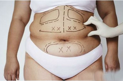 Những hình ảnh khiếp sợ về hút mỡ bụng